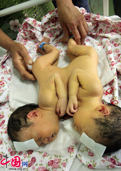 Conjoined twin girls rest at the Shandong Provincial Hospital in Jinan, East China&apos;s Shandong province, Sept 7, 2010. [CFP]