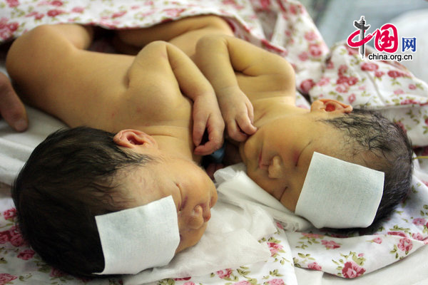 Conjoined twin girls rest at the Shandong Provincial Hospital in Jinan, East China&apos;s Shandong province, Sept 7, 2010. [CFP]