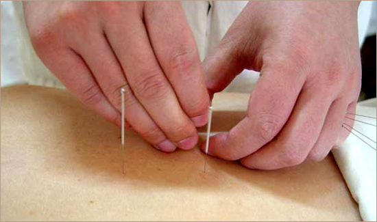 A patient receives acupuncture treatment  in this file photo. China is seeking to list acupuncture, the needle therapy of traditional Chinese medicine (TCM), as a UNESCO world intangible cultural heritage.