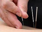 Acupuncture applies for intangible heritage status