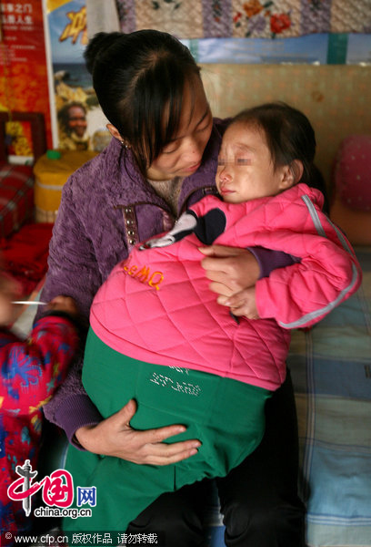 Girl At Has Swollen Belly Due To Unknown Disease China Org Cn