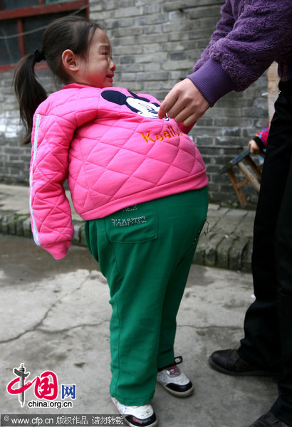 Xiaoyue (Front), aged 4 has been suffering from an unknown disease since she was eight months old, which makes her belly swollen to 1.06 meters in size at present. Her family members are still trying their best to cure her now despite of failed efforts in several hospitals in past years. (Xiaoyue is an alias for the sake of privacy) [CFP]