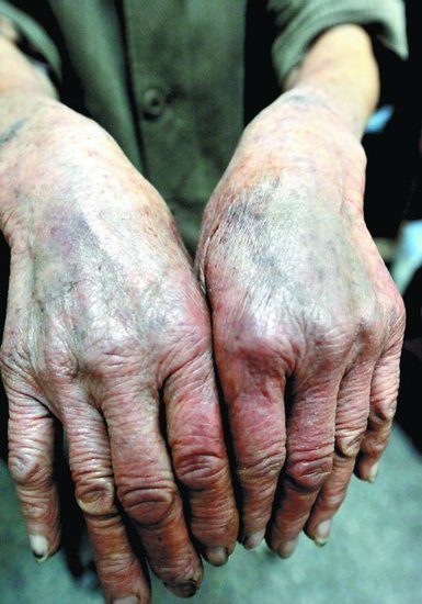 Jiang Xialian's bruised hands.