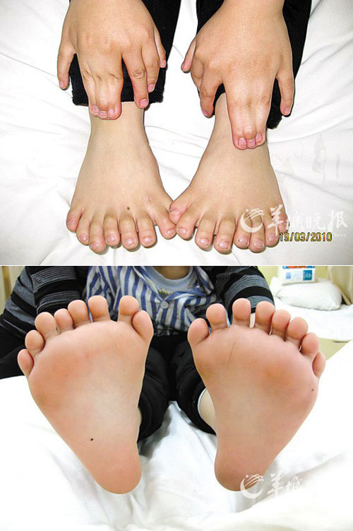 A 6-year-old boy from northeast China&apos;s Harbin city, Northeast China&apos;s Helongjiang province has 15 fingers and 16 toes, according to Shenyang Daily. [Yangcheng Evening News] 