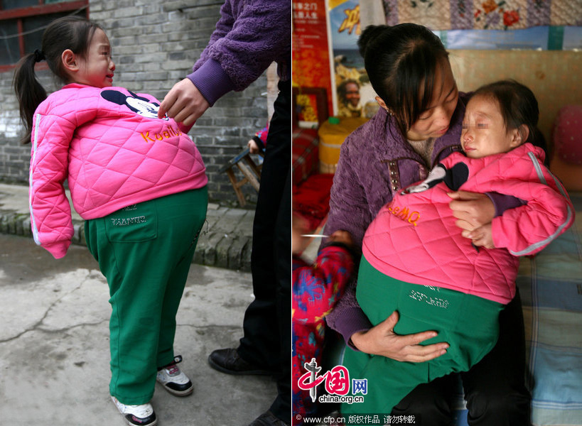 The girl has been suffering from an unknown disease since she was eight months old, which makes her belly swollen to 1.06 meters in size at present.