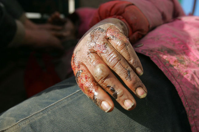 Scarred body of mentally disabled Liu Xiaoping is seen at home on December 19, 2010 in Gaoling county, Shaanxi Province of China. Liu was rescued by policemen from a illegal factory in Toksun county of Northwestern China&apos;s Xinjiang Uygur Autonomous Region.[Agencies]