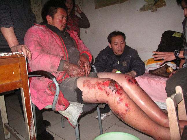 Scarred body of mentally disabled Liu Xiaoping is seen at home on December 19, 2010 in Gaoling county, Shaanxi Province of China. Liu was rescued by policemen from a illegal factory in Toksun county of Northwestern China&apos;s Xinjiang Uygur Autonomous Region.[Agencies]