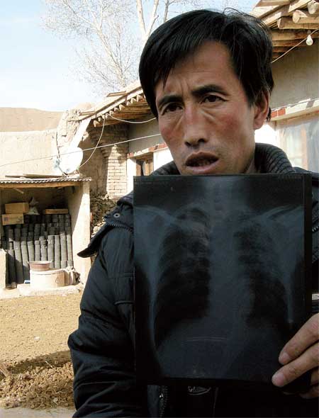 Shang Zhifa, a 41-year-old pneumoconiosis patient, holds the X-ray of his lungs at his home in the city of Jiuquan, Gansu Province, earlier this year. 