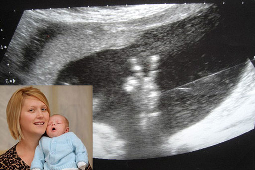 The baby's gesture from inside Louise's womb can clearly be seen on the 21-week ultrasound scan.