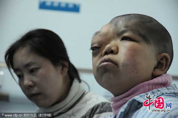 Wen Yonglan waits for an operation at the First Affiliated Hospital of Harbin Medical University on January 16, 2011 in Harbin, Heilongjiang Province of China. Wen Yonglan is a 16-year-old girl of Ewenke ethnic minority who had congenital skull defect and hydrocephalus. [Photo/CFP] 