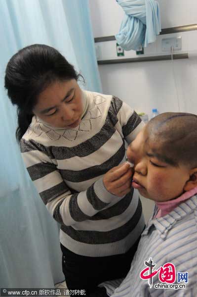 Wen Yonglan waits for an operation at the First Affiliated Hospital of Harbin Medical University on January 16, 2011 in Harbin, Heilongjiang Province of China. Wen Yonglan is a 16-year-old girl of Ewenke ethnic minority who had congenital skull defect and hydrocephalus. [Photo/CFP] 