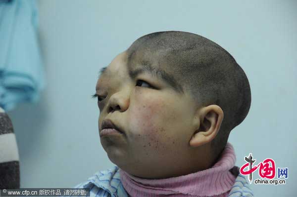 Wen Yonglan waits for an operation at the First Affiliated Hospital of Harbin Medical University on January 16, 2011 in Harbin, Heilongjiang Province of China. Wen Yonglan is a 16-year-old girl of Ewenke ethnic minority who had congenital skull defect and hydrocephalus. [Photo/CFP] 