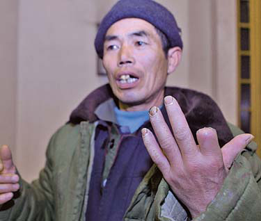 Migrant worker Dai Zhengsheng displays the hand he injured on a Beijing construction site in November in this photo taken last week. 
