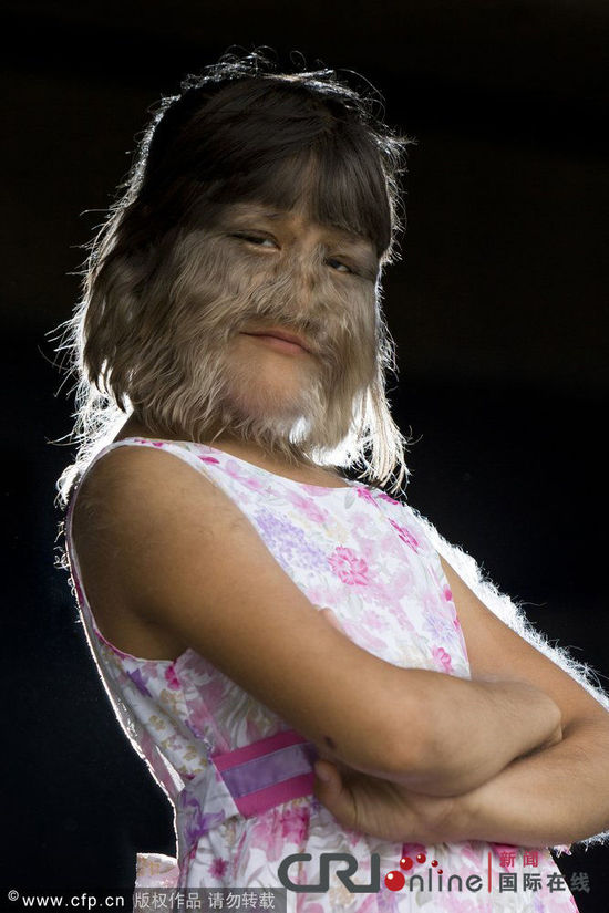 泰国11岁女孩患罕见多毛症酷似“狼人”(高清组图)