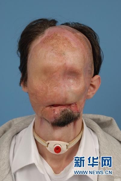 A 25-year-old Texas man, Dallas Wiens, has received the first full face transplant done in the United States at Boston's Brigham and Women's Hospital.