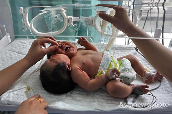 Conjoined twins that resemble a baby girl with two heads born on May 5 receive treatment at a hospital in Suining, Sichuan province, on Monday. The twins, 51cm long and weighing 4.05 kg, are still in a dangerous condition. The case is the first of its kind in China. [Asianewsphoto]