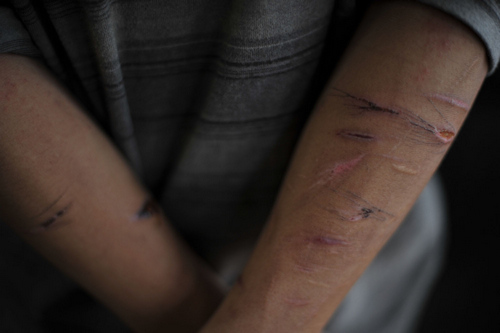 This undated photo shows scars on the arms of Wang Yaxing, a worker at the brick kiln. 