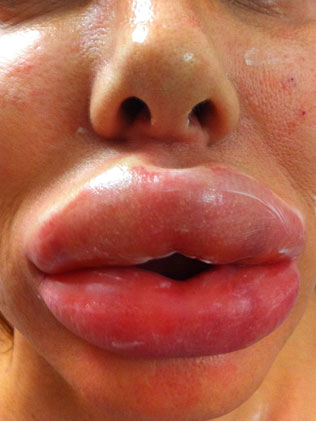 Her lips were left dramatically swollen.