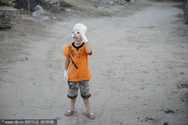 Little Xiangxiang fiddles with the medical mask protecting his burns while playing in Fenyang city, North China's Shanxi province, June 20, 2011. 