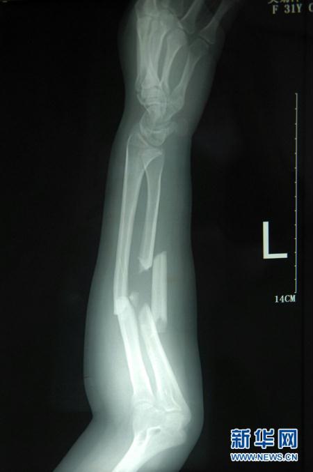 Wu&apos;s arm was injured in the accident. 