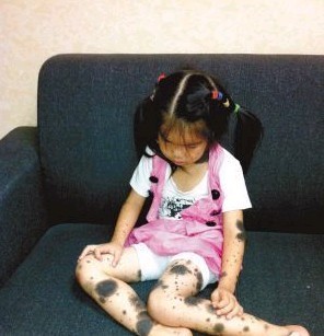 Girl covered with moles gets first surgery in city. 
