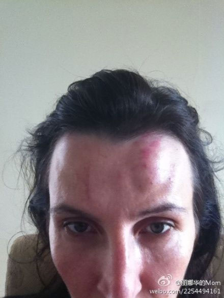 The photo posted on the Weibo of 'Li Na Hua's Mom' shows her injured forehead. [weibo.com]