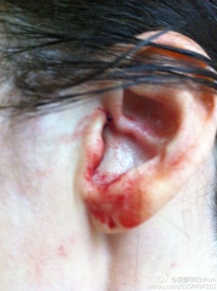 The photo posted on the Weibo of 'Li Na Hua's Mom' shows that one of her ears is bleeding. [weibo.com]