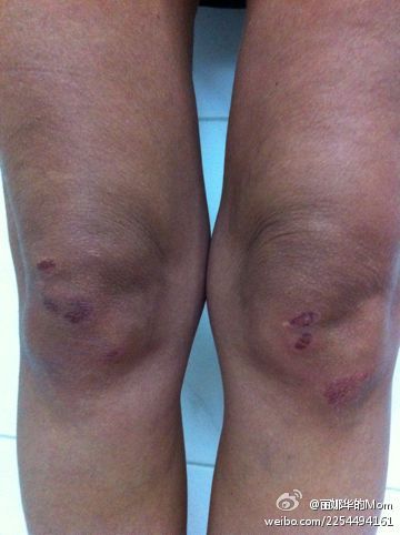 The photo posted on the Weibo of 'Li Na Hua's Mom' shows her injured knees. [weibo.com]