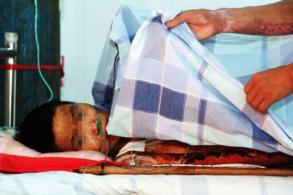 Wang Biwen, who is HIV positive, lies in a bed at Yingde People's Hospital in Guangdong province on Sept 13. The woman, who suffered severe burns to 85 percent of her body, was refused treatment at several hospitals.