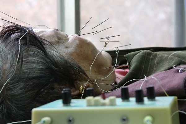A patient suffering from facial paralysis receives acupuncture treatment at a hospital in Nanjing, the capital of Jiangsu province, on Dec 6, 2010.