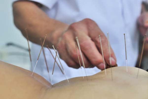 A doctor applies acupuncture treatment to a patient in Zouping, Shandong province in this July 19, 2011 file photo.