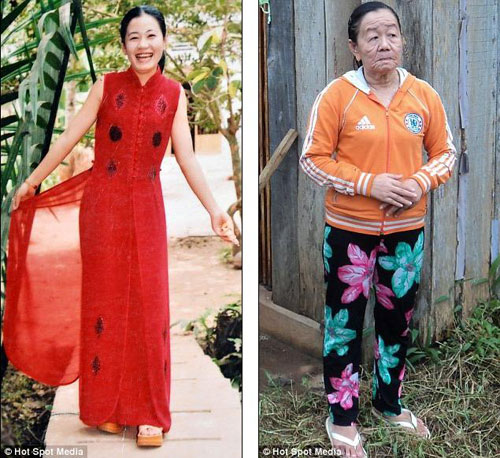 Rapid ageing: A mystery condition has apparently caused Nguyen Thi Phuong's face to sag and wrinkle over a matter of day. She is pictured aged 21 on the left and 26 on the right. [Agencies]