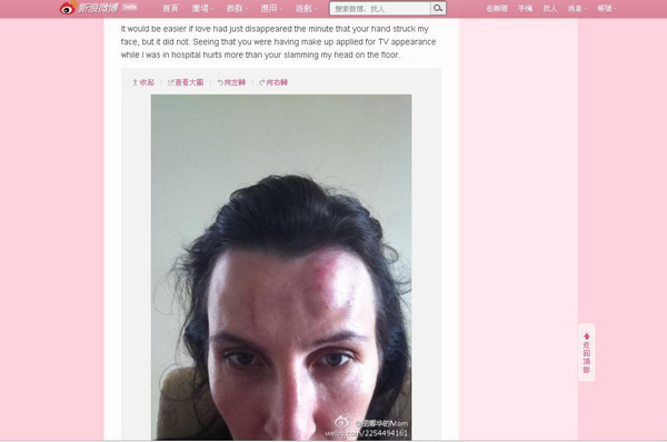 Kim Lee posted this photo of her swollen forehead online as an accusation against her husband. [Photos/China Daily] 