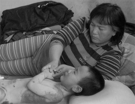 Guo Liqing attempts to calm down her 4-year-old son Wang Zining, who cries in pain whenever ointment is rubbed into his newly grafted skin. The family lives in Xingtang, Hebei province. [Photo/ China Daily]