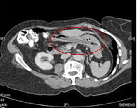 This abdominal CT scan clearly shows the pen siting in the woman's stomach. [Agencies]