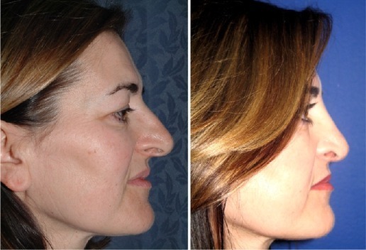 Observers decided the patients looked a year or two younger, on average, with their new noses than pre-surgery.