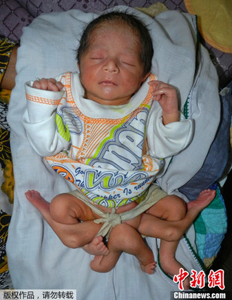 The one-week-old boy is believed to be one half of parasitic twins.
