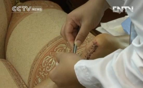 Liu reveals a 20cm long scar, four times longer than that of his first operation four years ago. It will take him at least six months before he can walk normally again.