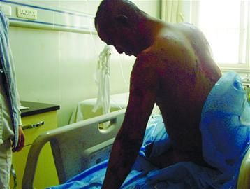 Wu is seriously injured after burning himself on Nov 23. [Photo/ jxnews.com.cn]