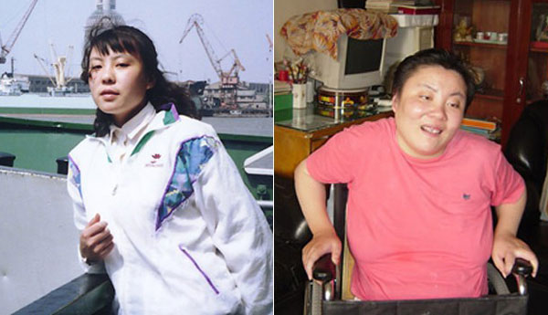 Zhu Ling before (L) and after the poisoning. [Beijing News]