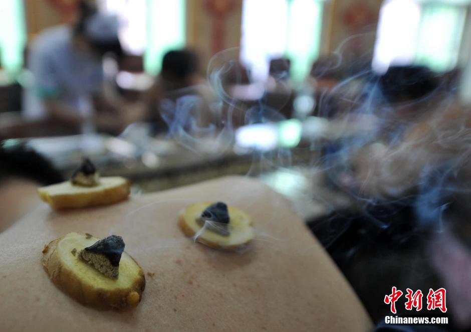 In this hot summer, a traditional Chinese therapy is very popular in Fuzhou, the capital of China's Fujian province. [Photo/Chinanews.com]