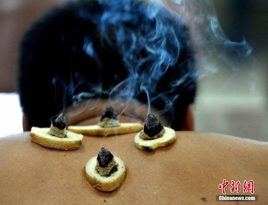 In this hot summer, a traditional Chinese therapy is very popular in Fuzhou, the capital of China's Fujian province. [Photo/Chinanews.com]