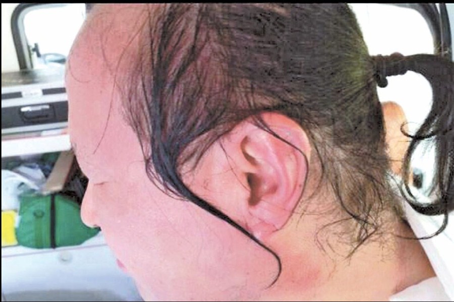 Jiang Jiyue suffered second-degree burns on the left side of his face.