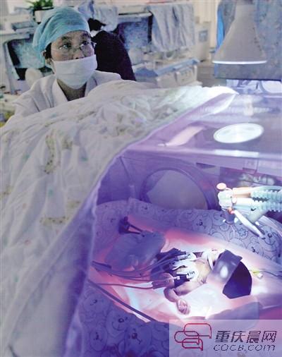 资料图:11月17日,西南医院儿科监护室,23周的早产儿筷子宝宝在保温