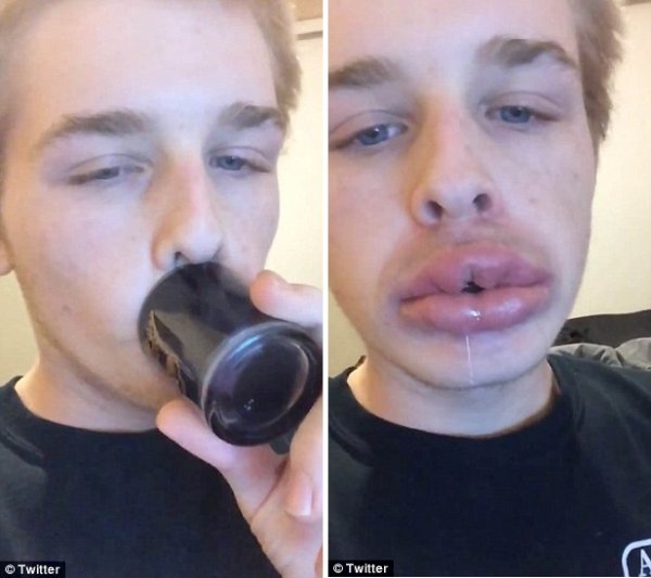 青少年为获性感丰满嘴唇用容器吸肿双唇 效果惨不忍睹