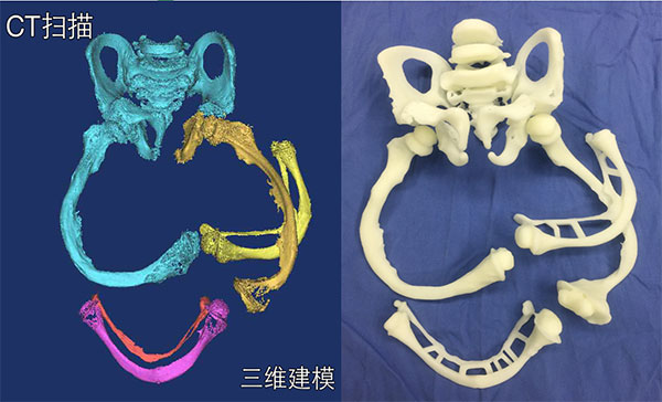 A 3-D-model of his lower limbs based on a CT scan, and the same model printed in 3-D (above right), enabled doctors to precisely examine his illness. CHEN WEN/CHINA NEWS SERVICE/CHINA DAILY