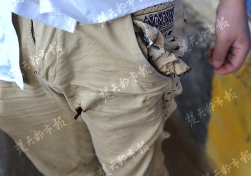 The man’s trousers were burned. [Photo/ Chutian Metropolis Daily]