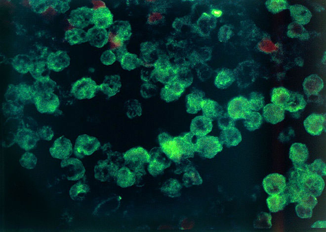 An infection of the amoeba Naegleria fowleri, seen under a microscope.[Photo: livescience.com]