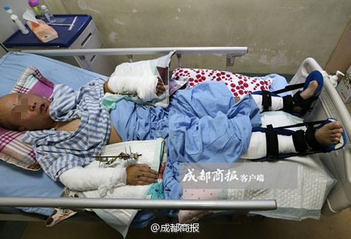 Wei Hua, a panda keeper in southwest China's Sichuan Province, had both wrists broken by a panda recently. [Chengdu Economic Daily] 
