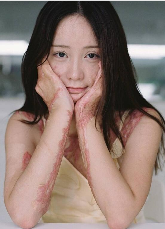 A 21-year-old young woman who was a victim of disfigurement five years ago courageously faced the public eye, recently posting a series of glamor photographs on the internet.